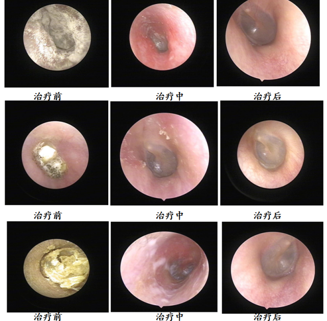1681897781119715.png 耳内镜下真菌治疗效果对比展示.png